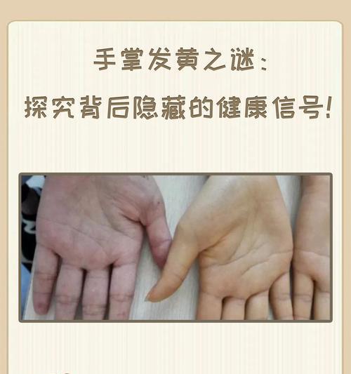 鹅掌叶子发黄的原因及解决方法是什么？